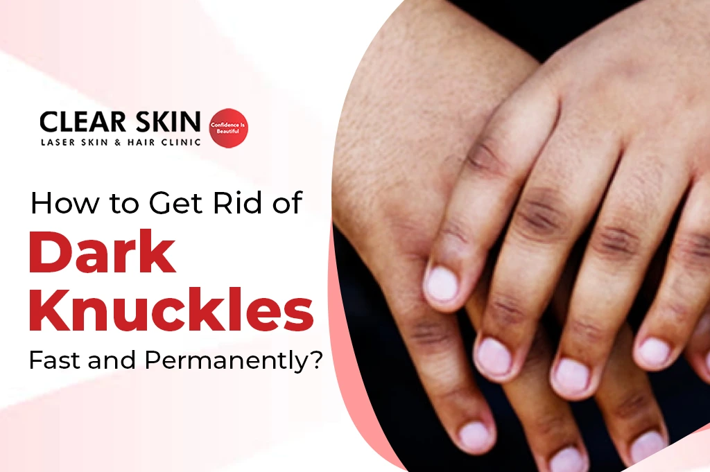 How to Get Rid of Dark Knuckles Fast and Permanently?