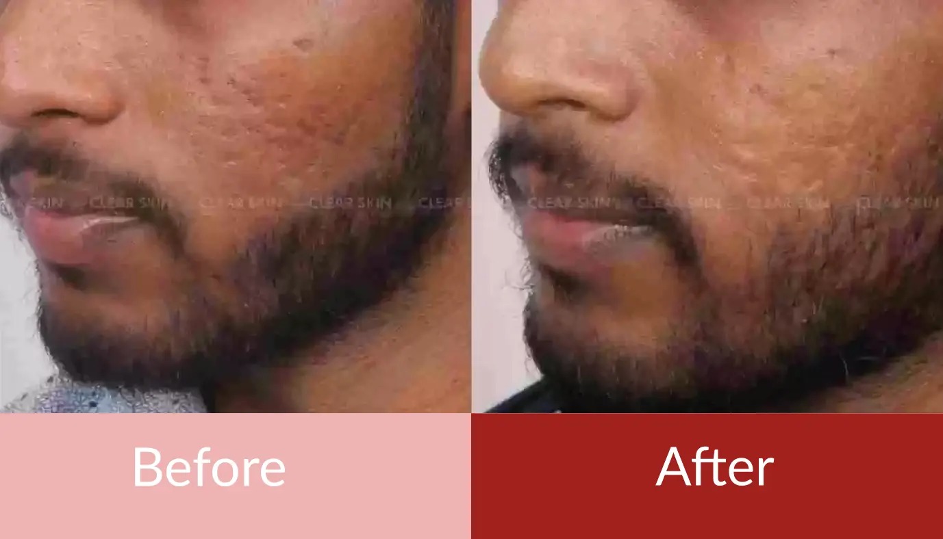 treatment for acne scars in pune