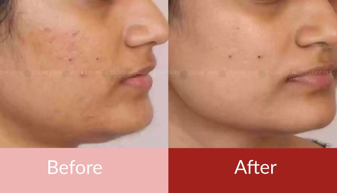 acne scar removal in pune