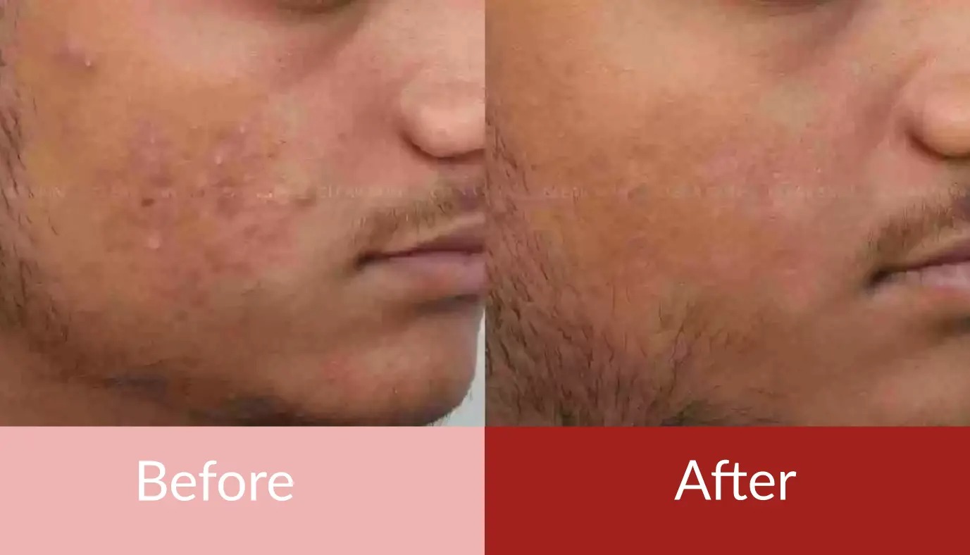 Treatment for acne scars removal before after photos