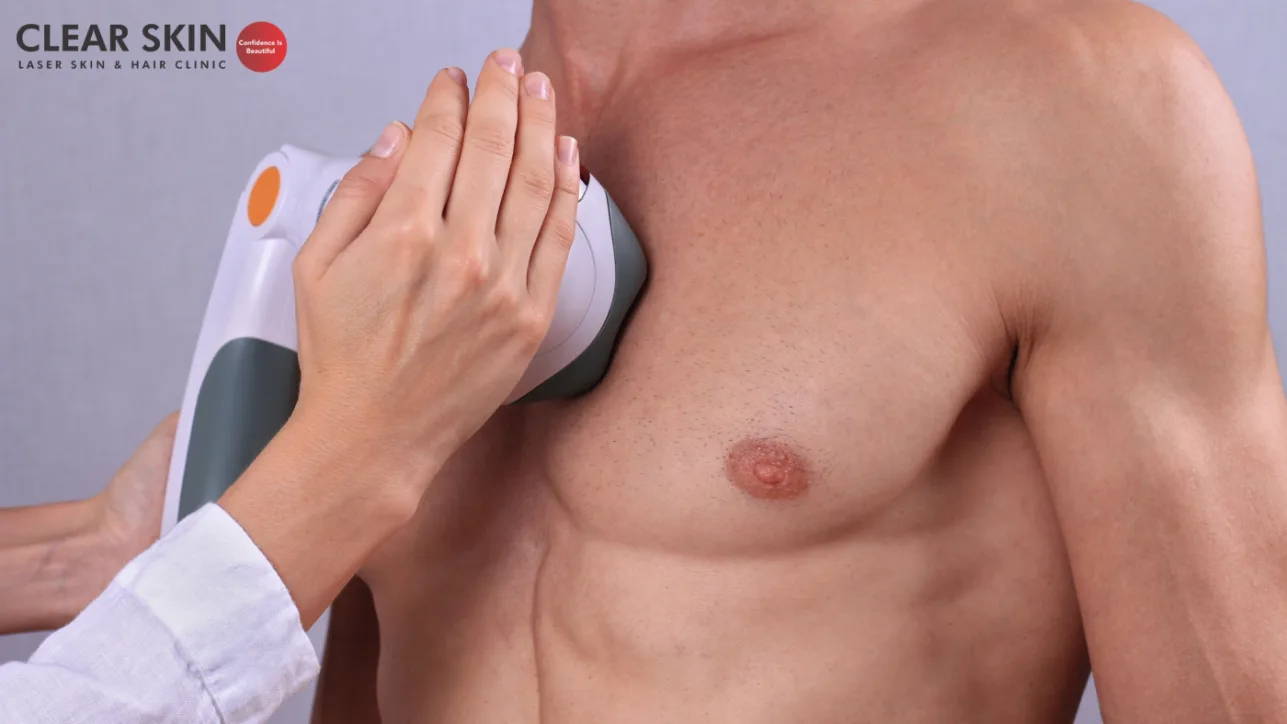 The Benefits of Laser Hair Removal For Men