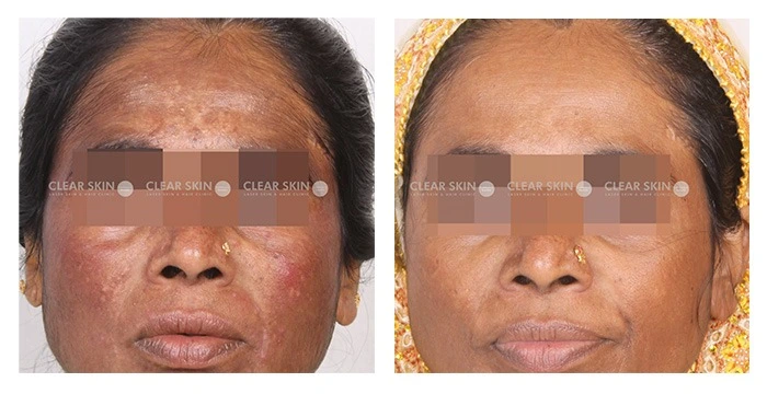 pigmentation before and after results