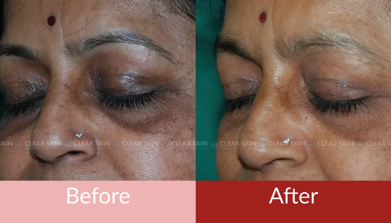 Regenerative Treatment for Under Eye Wrinkles and Bags | New York