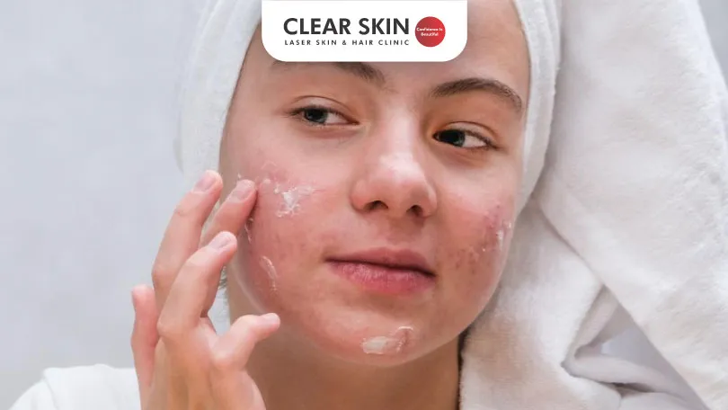 Dermatologist’s Guide on How to Reduce Redness of Acne Clear Skin Pune