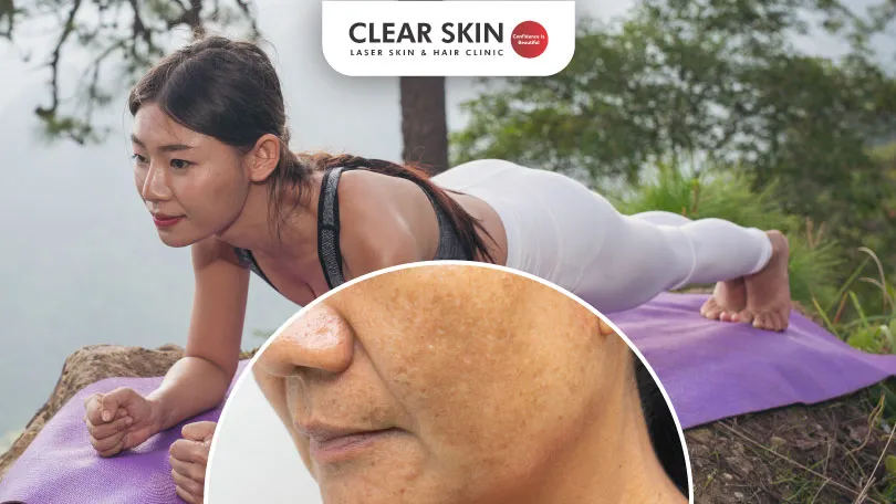 Can Yoga Combat Melasma?