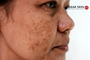 Who is at the Risk of Melasma?