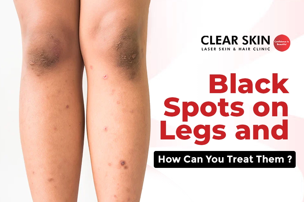 5 Effective Ways To Fade Dark Spots On Your Legs