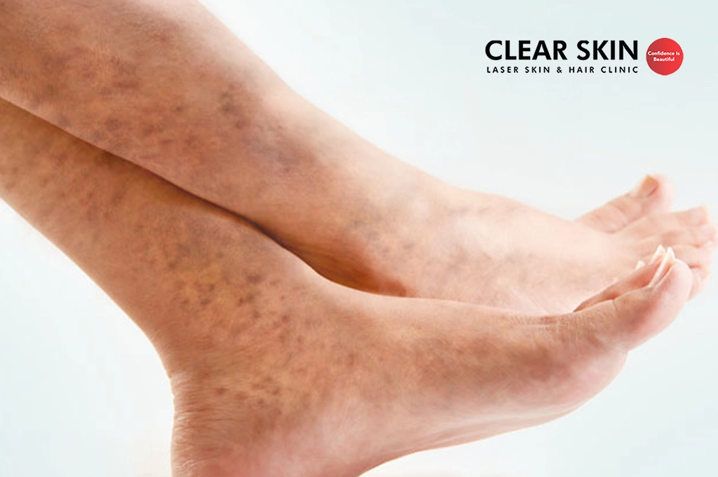 How to Remove Old Scars and Black Spots on the Legs