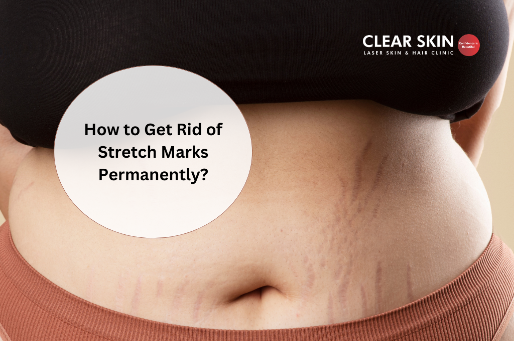 Stretch Mark Removal: What Really Works?- Get Rid of Stretch Marks