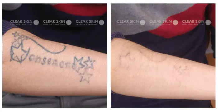 Before During and After Tattoo Removal Photos  Skin Renew