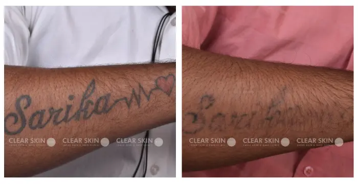 Laser tattoo removal before and after  Redeem Hull