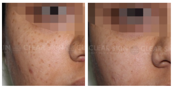 Freckles before after results