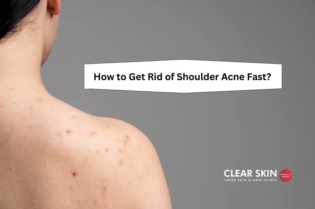 How to Get Rid of Shoulder Acne Fast?
