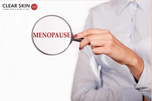 Connection between Melasma and Menopause
