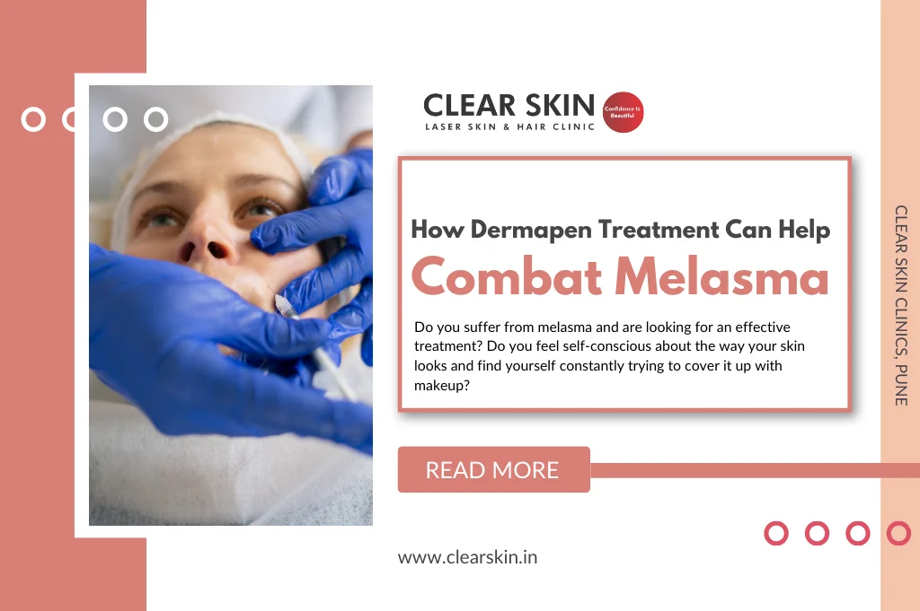 How Dermapen Treatment Can Help Combat Melasma?