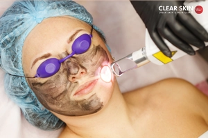 How Does Carbon Laser Facial Work?