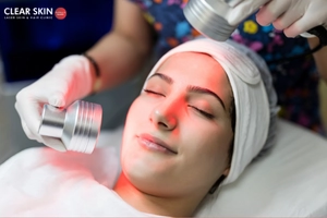 Does Red Light Therapy Make Melasma Worse?