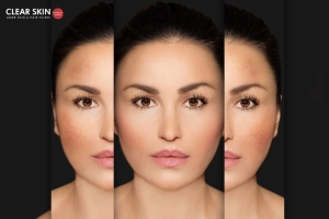 How does Laser Hair Removal Cause Pigmentation Changes? 
