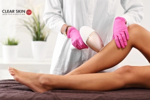 Is Laser Hair Removal Effective for Dark Skin People?