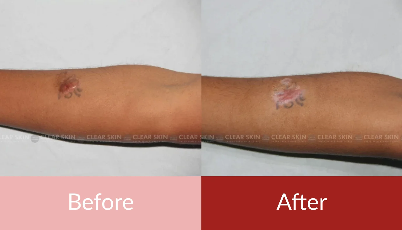 Permanent Tattoo Removal Procedures | Dr Agarwal's Clinic, Siliguri