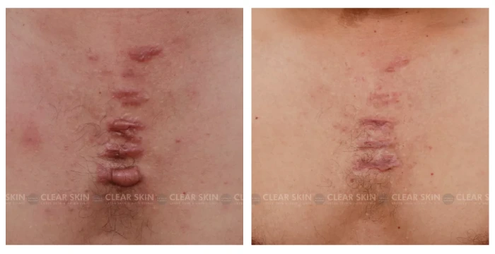 Keloid before after results