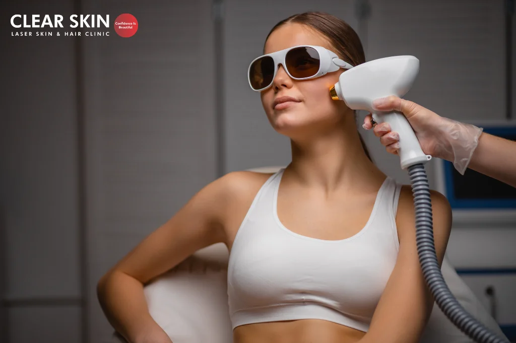 Laser Hair Removal on the Face