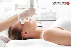 Laser Therapy for Melasma 