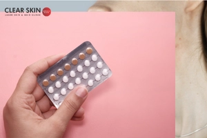 The Link Between Melasma and Birth Control Pills