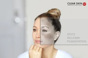 What Are the Causes of Melasma?