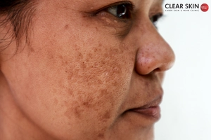 What Is Melasma and Pigmentation?