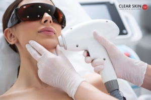 What Type of Laser Hair Removal is Best?