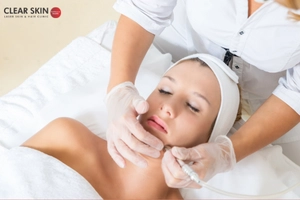 What is Microdermabrasion?