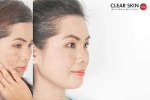What to Expect after Laser Treatment For Melasma?