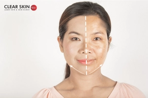 How to Treat Melasma from Inside?
