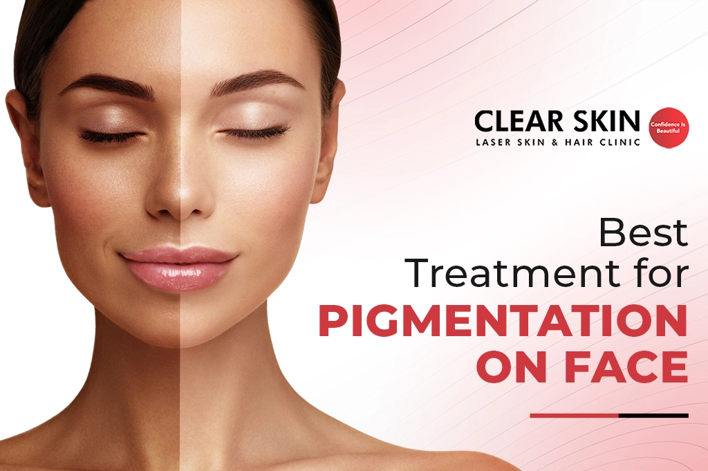 Discover the Best Treatment for Pigmentation on Face