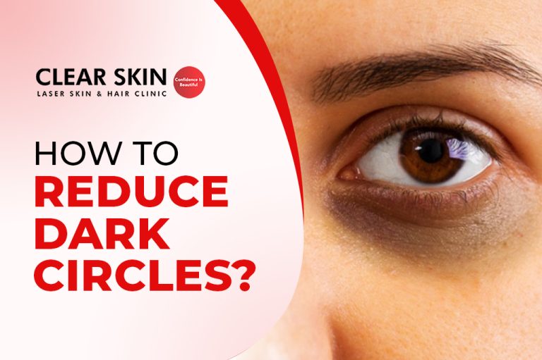 How To Reduce Dark Circles Causes Treatment Clear Skin