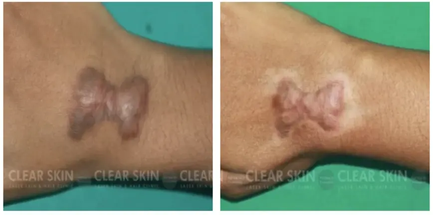 Hypertrophic Acne Scar Before After Results