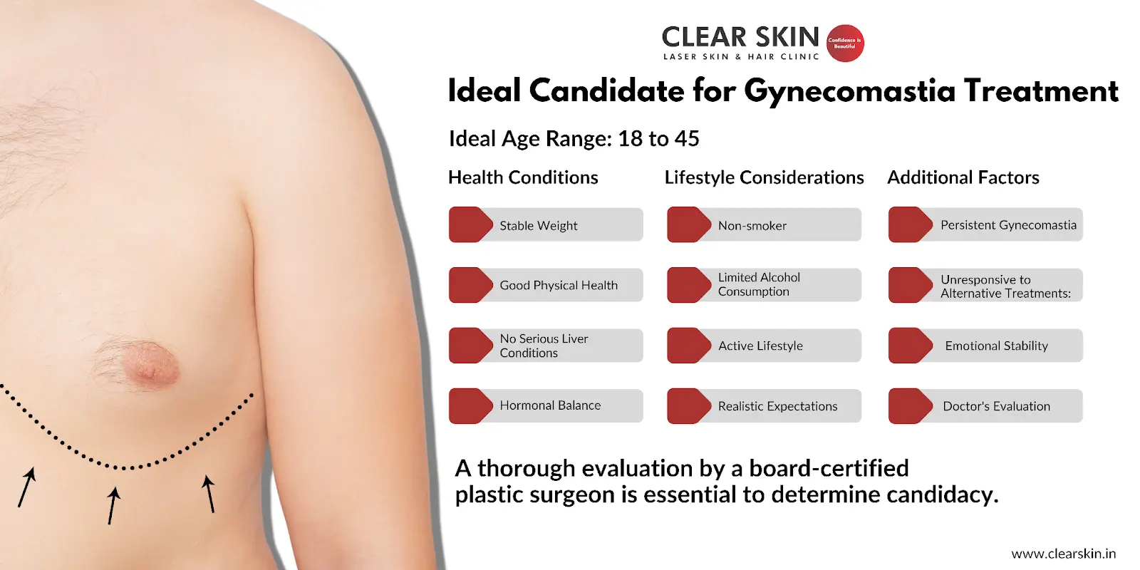 Ideal Candidate for Gynecomastia Treatment
