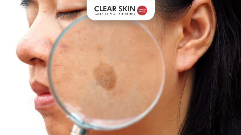 Is Melasma Cancerous?