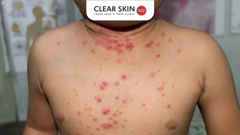 All you need to know about Molluscum Contagiosum clear skin pune