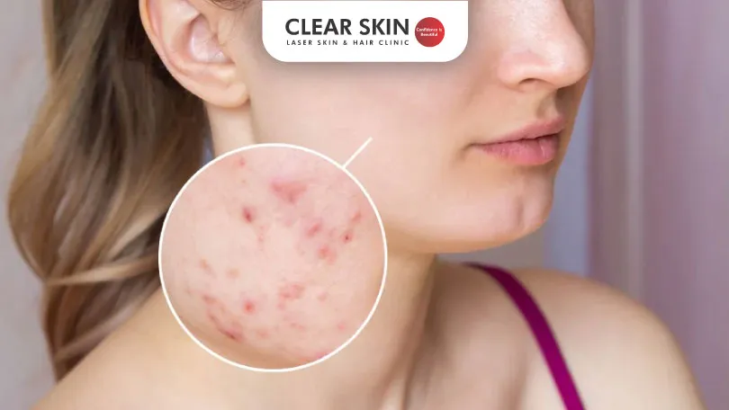 How to Identify and Treat Fungal Acne clear skin pune