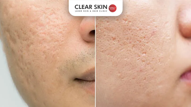 Ultimate Guide How to Remove Acne Scars Effectively clear skin pune