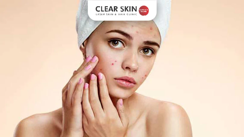 17 Home Remedies to End Your Acne Woes clear skin pune