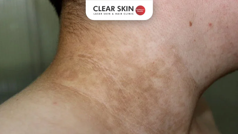 Acanthosis Nigricans Treatment – How to Get Rid of Black Neck?