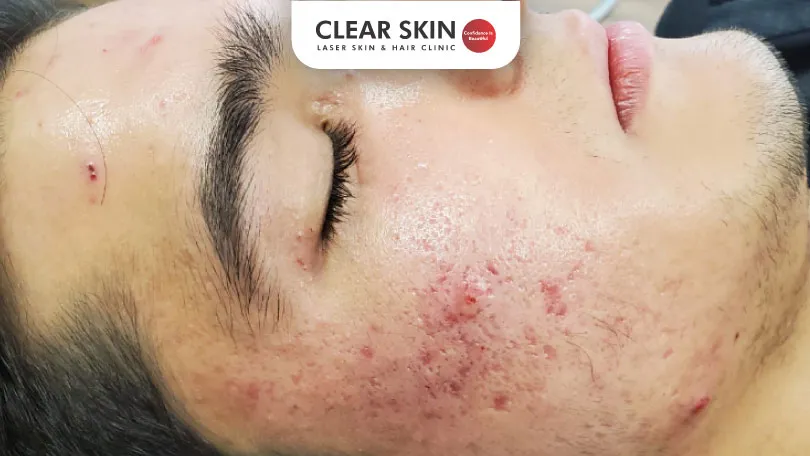 Acne Pits Various Treatment Modalities That Heal Your Skin Clear Skin Pune