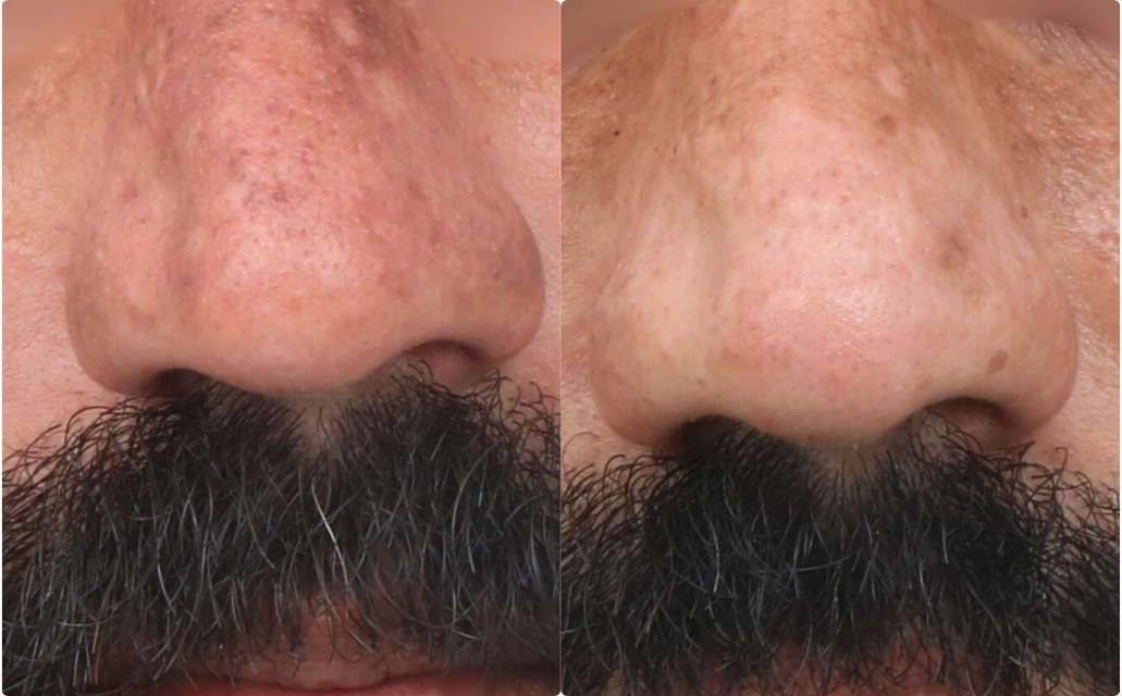 Acne Scars Results 6 Months 6 Sessions Timeline Clear Skin Pune