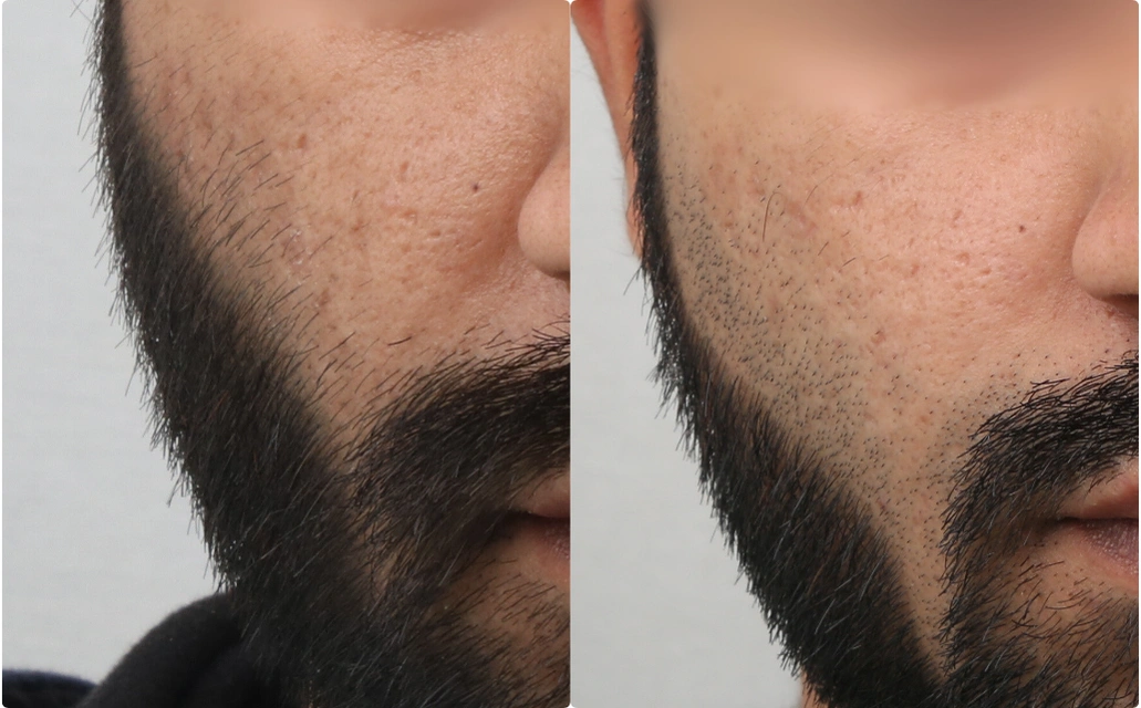 Acne Scars Results 6 Months 6 Sessions Timeline Clear Skin Pune 1