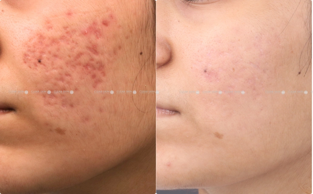 Acne Scars Results 6 Months Timeline Clear Skin Pune