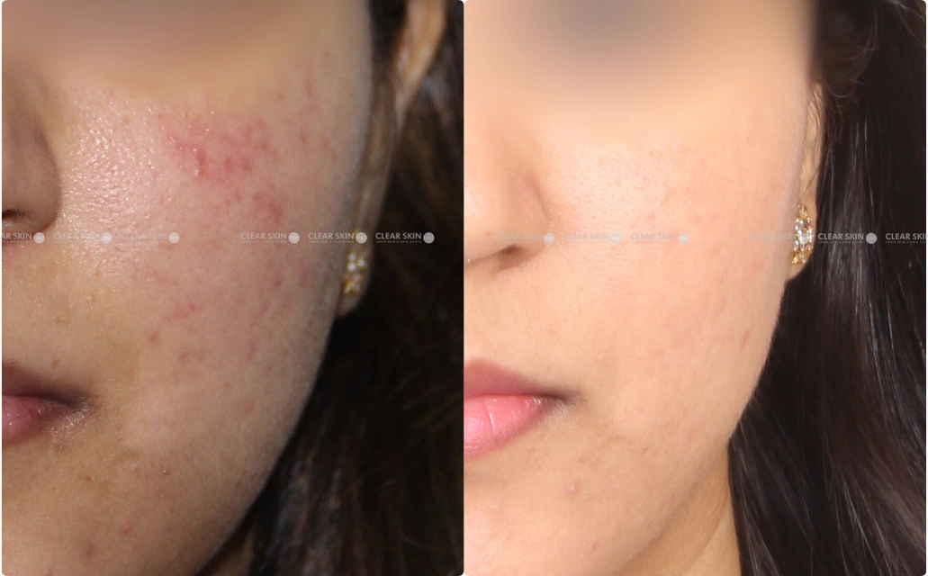 Acne Scars Results 6 Months Timeline Clear Skin Pune 2