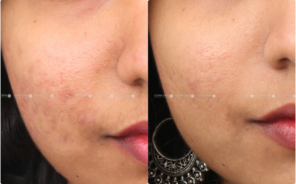 Acne Scars Results 6 Months Timeline Clear Skin Pune 3